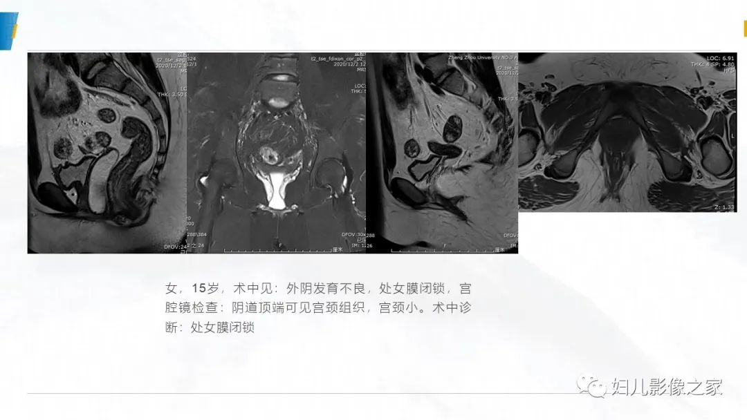 影像PPT - 【PPT】阴道积血3例诊断及鉴别诊断-25