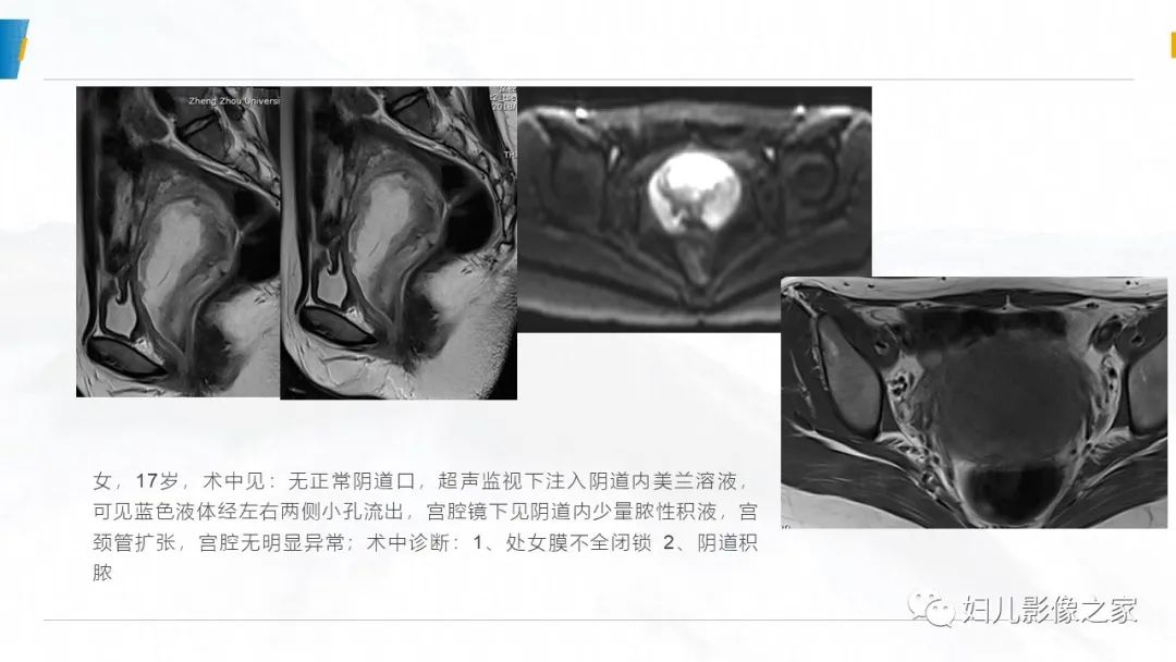 影像PPT - 【PPT】阴道积血3例诊断及鉴别诊断-26