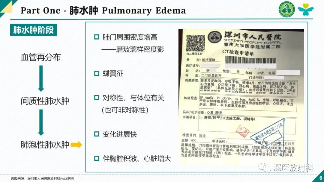 影像PPT - 【PPT】肺水肿、ICU影像及肺癌-6
