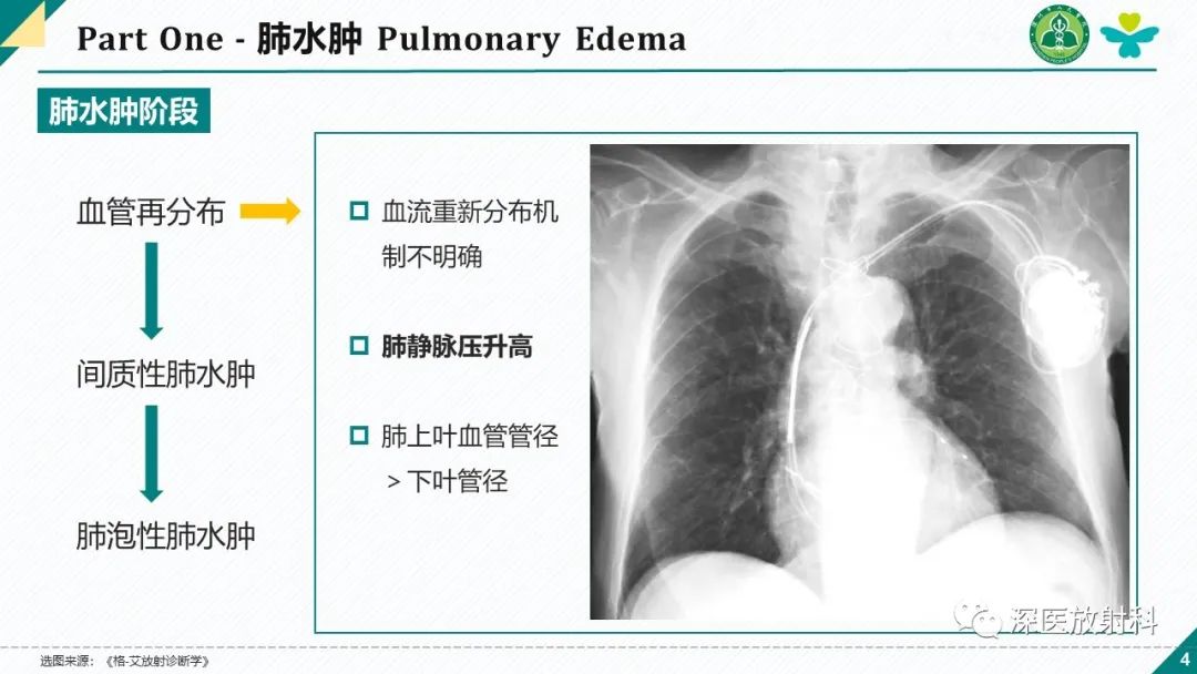 影像PPT - 【PPT】肺水肿、ICU影像及肺癌-4