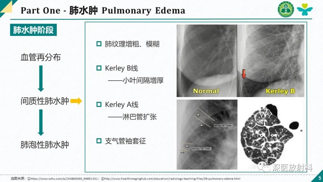 影像PPT - 【PPT】肺水肿、ICU影像及肺癌-5