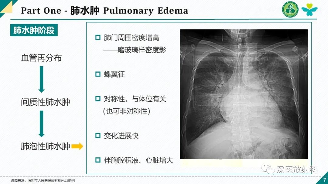 影像PPT - 【PPT】肺水肿、ICU影像及肺癌-7