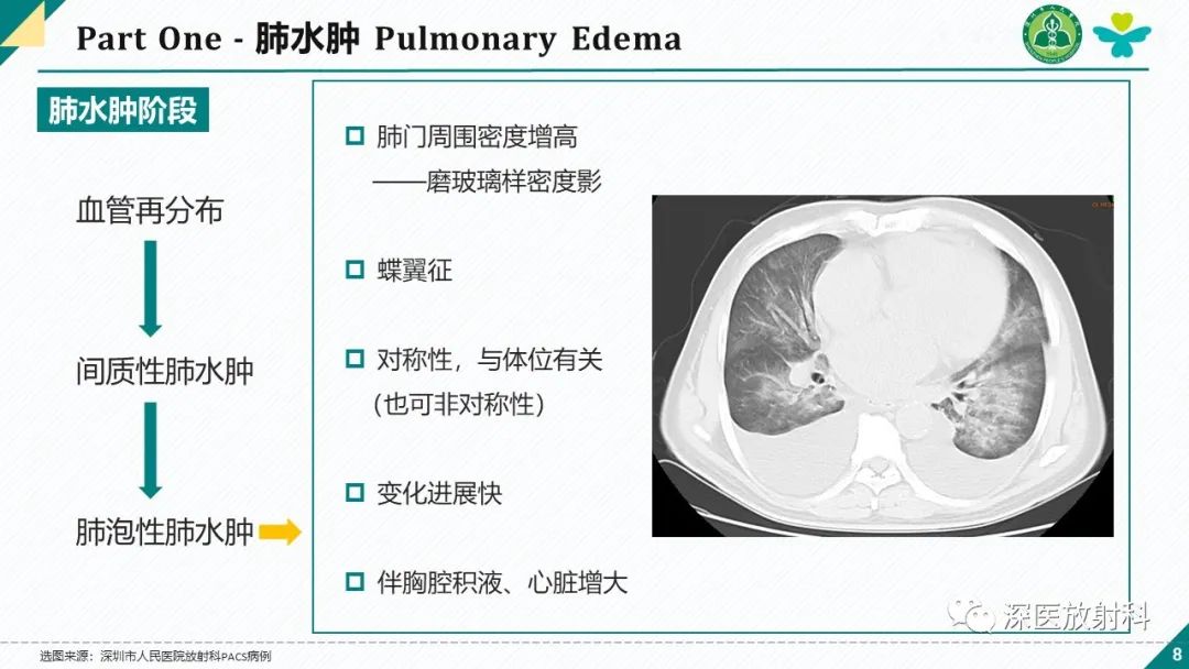 影像PPT - 【PPT】肺水肿、ICU影像及肺癌-8