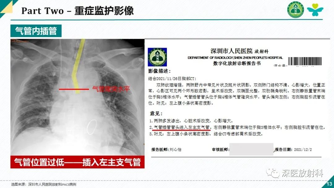 影像PPT - 【PPT】肺水肿、ICU影像及肺癌-13