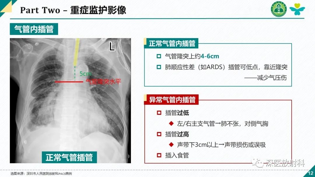 影像PPT - 【PPT】肺水肿、ICU影像及肺癌-12