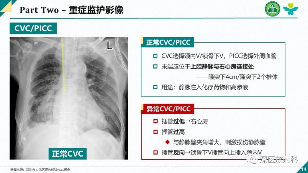 影像PPT - 【PPT】肺水肿、ICU影像及肺癌-14