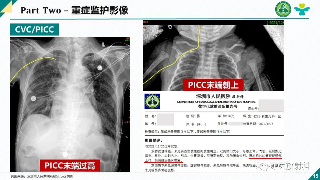 影像PPT - 【PPT】肺水肿、ICU影像及肺癌-15