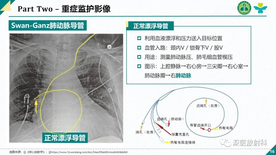 影像PPT - 【PPT】肺水肿、ICU影像及肺癌-16
