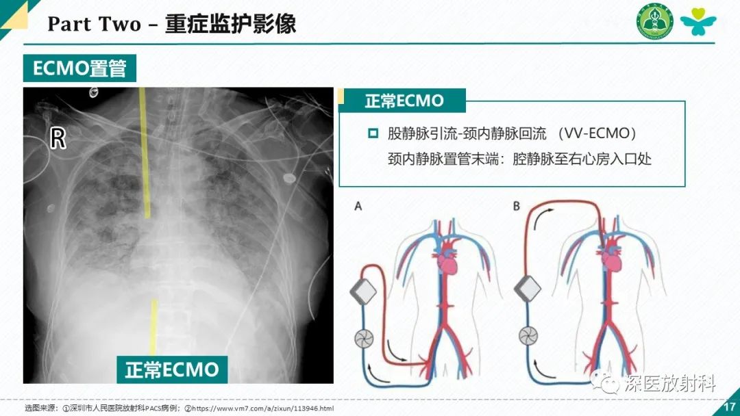 影像PPT - 【PPT】肺水肿、ICU影像及肺癌-17