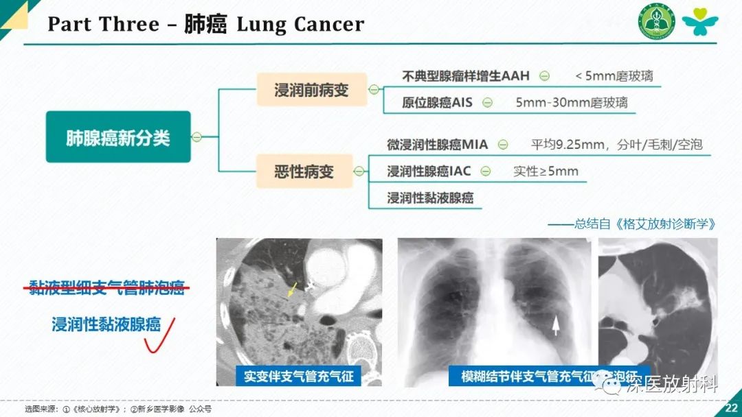 影像PPT - 【PPT】肺水肿、ICU影像及肺癌-22