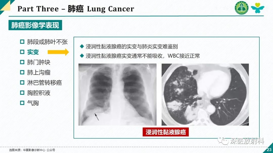影像PPT - 【PPT】肺水肿、ICU影像及肺癌-23