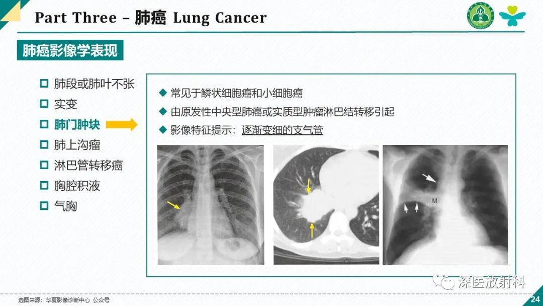 影像PPT - 【PPT】肺水肿、ICU影像及肺癌-24