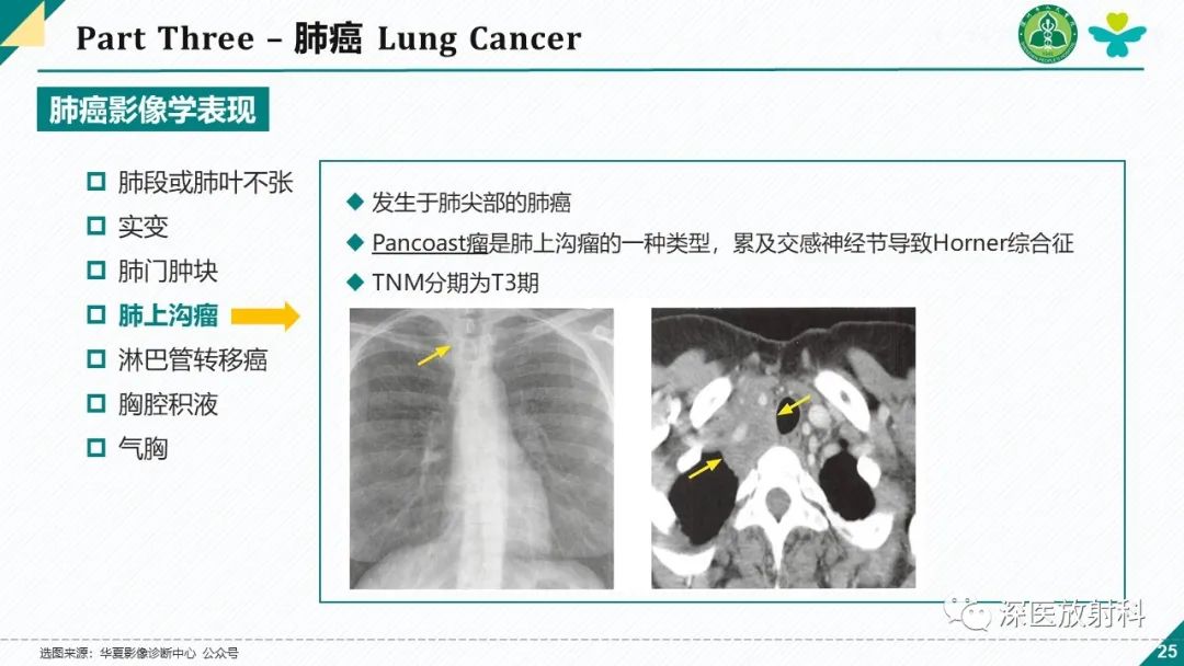 影像PPT - 【PPT】肺水肿、ICU影像及肺癌-25