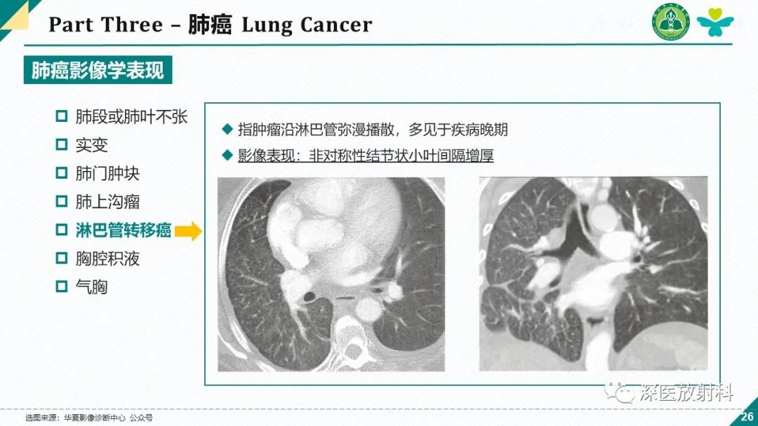 影像PPT - 【PPT】肺水肿、ICU影像及肺癌-26