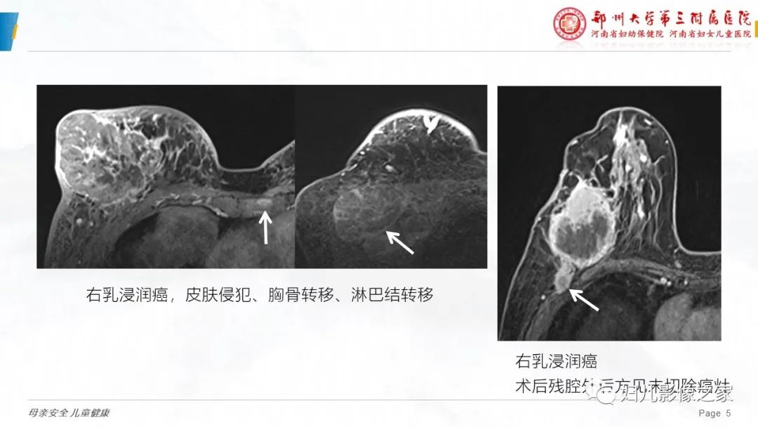 影像PPT - 【PPT】MRI新技术在乳腺疾病诊断中的应用-5