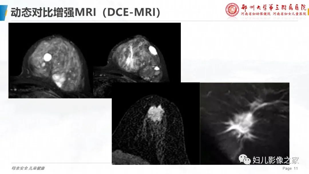 影像PPT - 【PPT】MRI新技术在乳腺疾病诊断中的应用-11