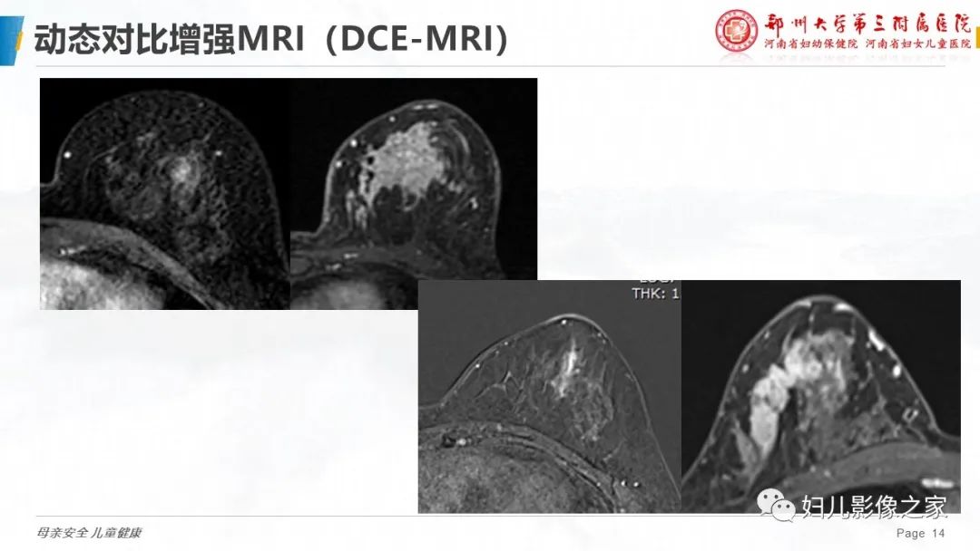 影像PPT - 【PPT】MRI新技术在乳腺疾病诊断中的应用-14