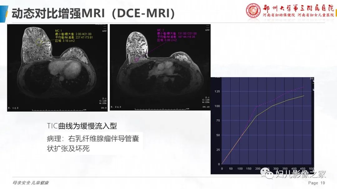 影像PPT - 【PPT】MRI新技术在乳腺疾病诊断中的应用-19