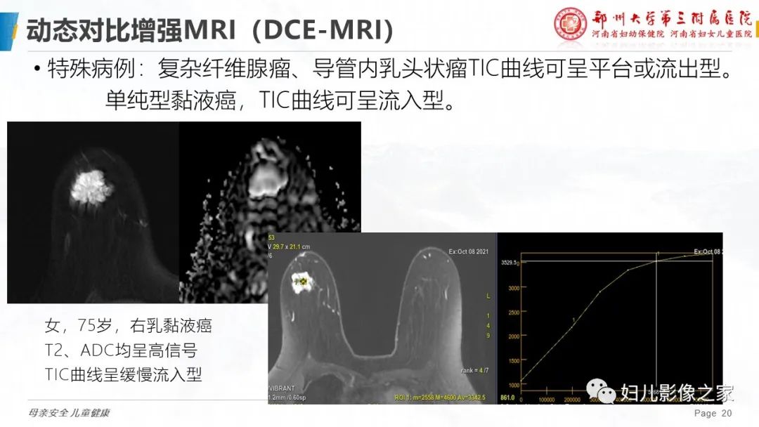 影像PPT - 【PPT】MRI新技术在乳腺疾病诊断中的应用-20