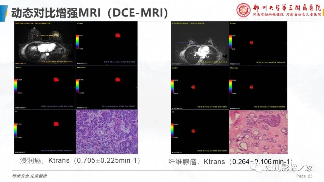 影像PPT - 【PPT】MRI新技术在乳腺疾病诊断中的应用-23