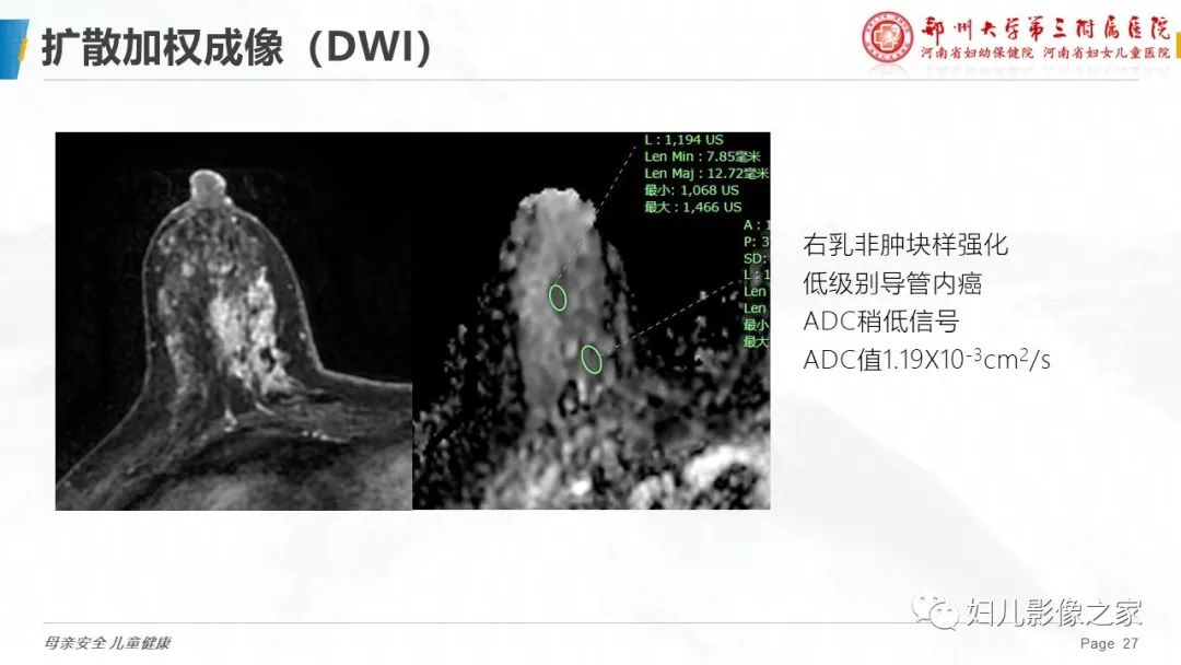 影像PPT - 【PPT】MRI新技术在乳腺疾病诊断中的应用-27