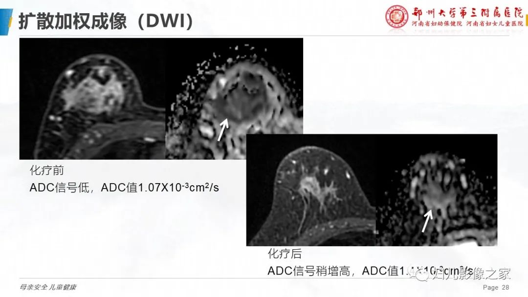 影像PPT - 【PPT】MRI新技术在乳腺疾病诊断中的应用-28