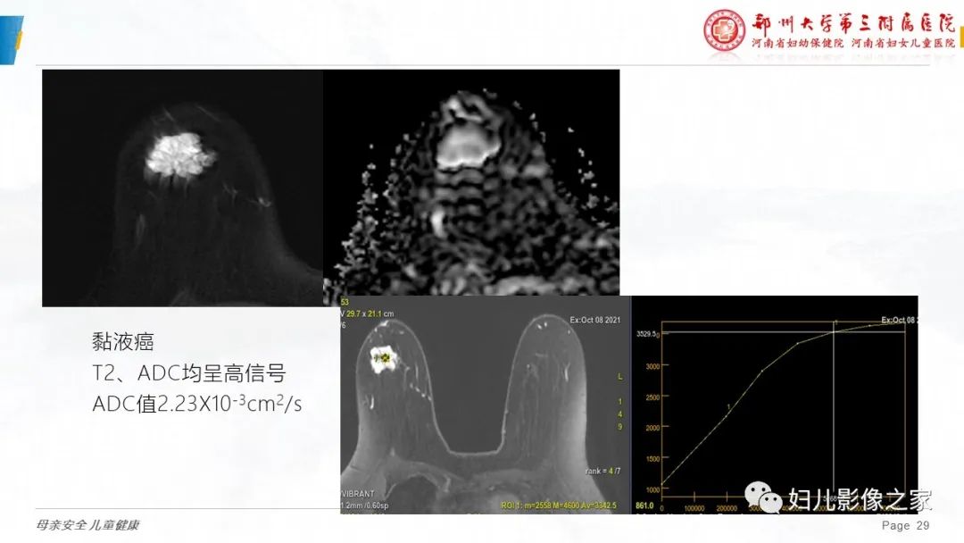 影像PPT - 【PPT】MRI新技术在乳腺疾病诊断中的应用-29