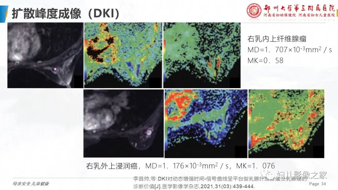 影像PPT - 【PPT】MRI新技术在乳腺疾病诊断中的应用-34