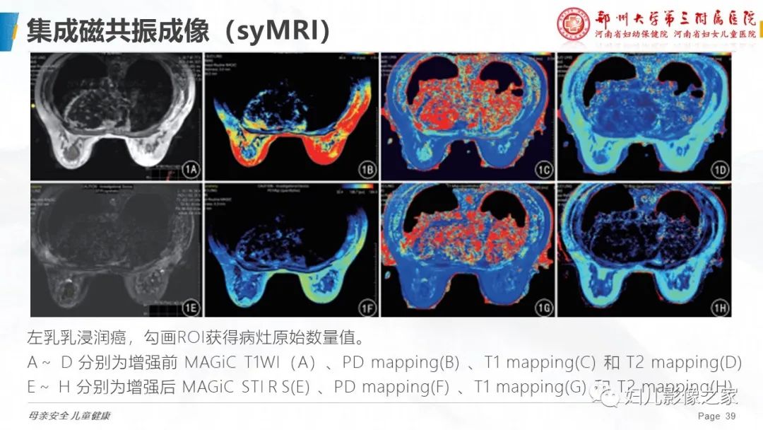 影像PPT - 【PPT】MRI新技术在乳腺疾病诊断中的应用-39