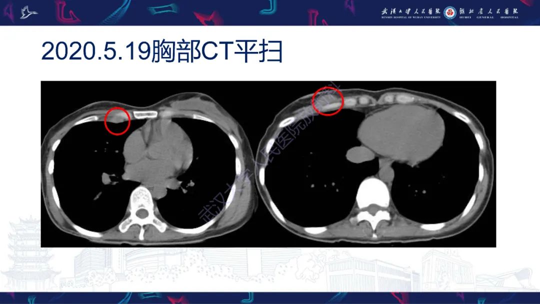 影像PPT - 【PPT】乳腺癌淋巴结影像评估-3