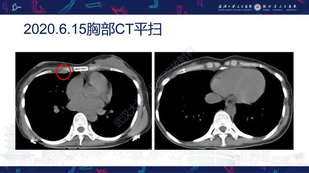 影像PPT - 【PPT】乳腺癌淋巴结影像评估-6