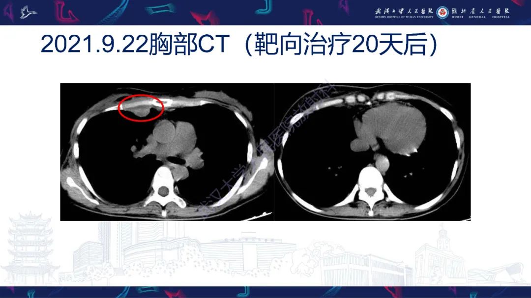 影像PPT - 【PPT】乳腺癌淋巴结影像评估-10