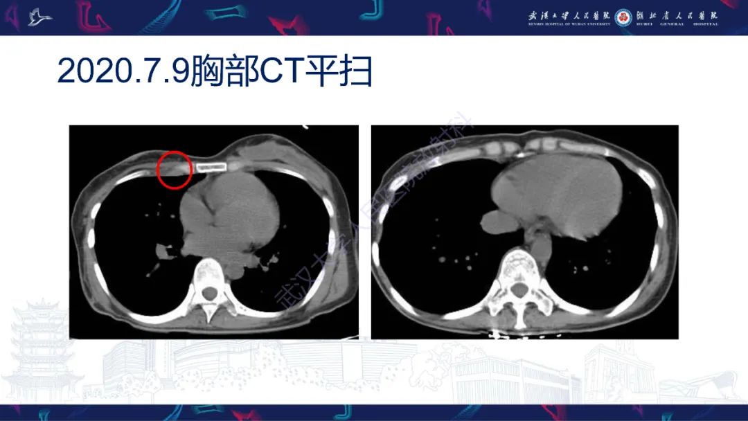 影像PPT - 【PPT】乳腺癌淋巴结影像评估-7