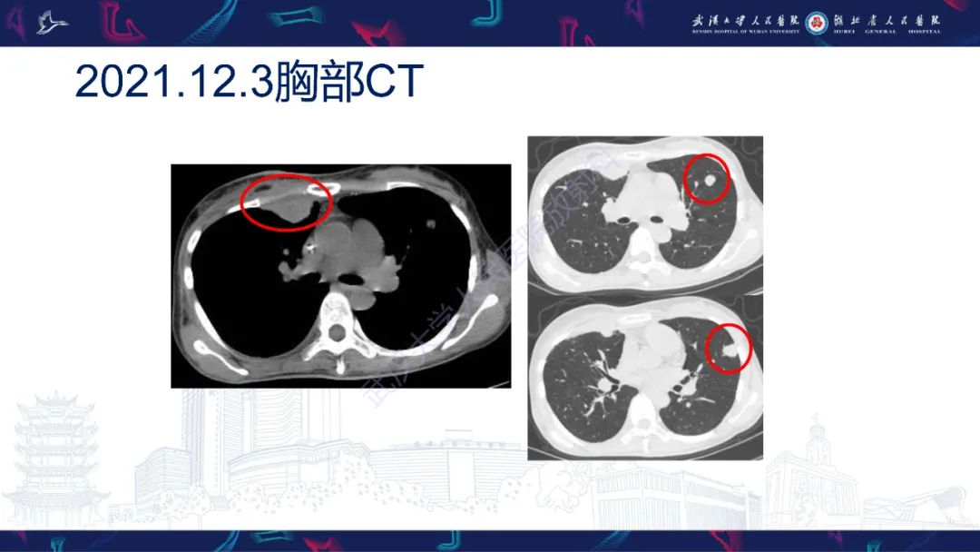 影像PPT - 【PPT】乳腺癌淋巴结影像评估-12