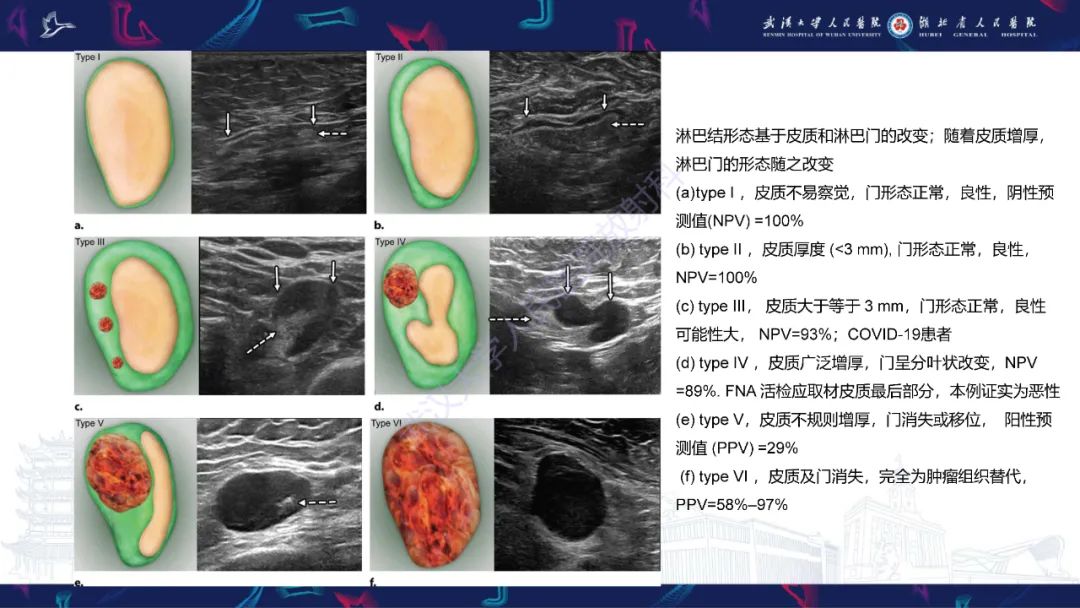 影像PPT - 【PPT】乳腺癌淋巴结影像评估-17