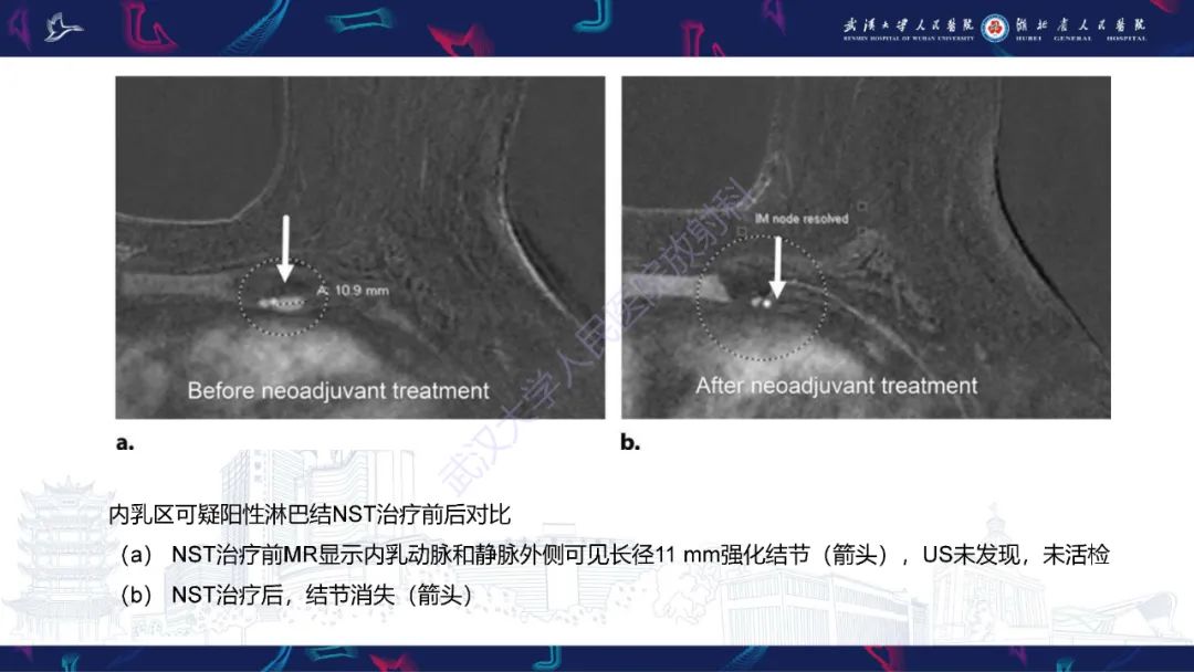 影像PPT - 【PPT】乳腺癌淋巴结影像评估-23