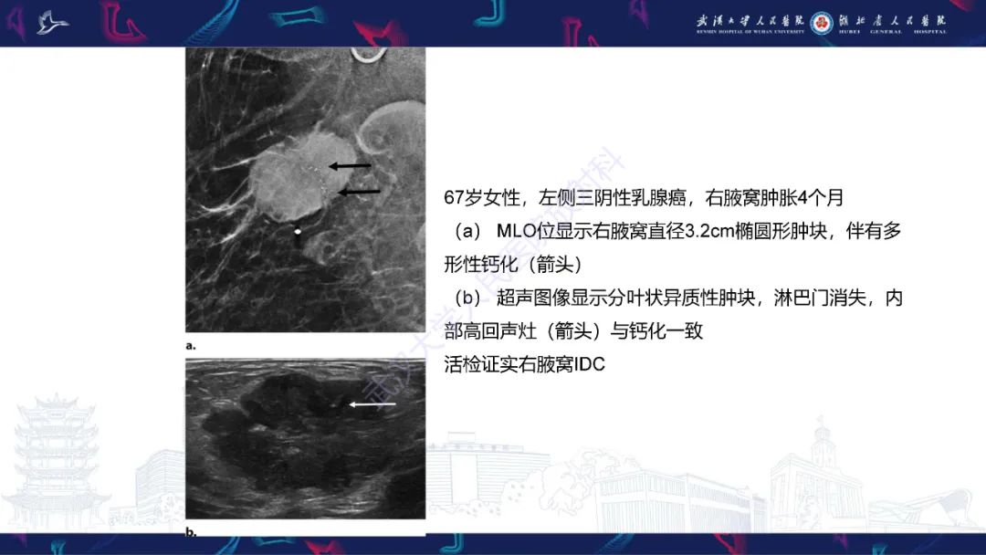 影像PPT - 【PPT】乳腺癌淋巴结影像评估-27