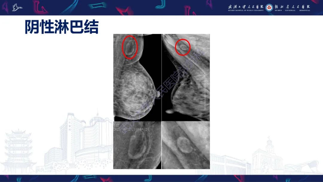 影像PPT - 【PPT】乳腺癌淋巴结影像评估-29