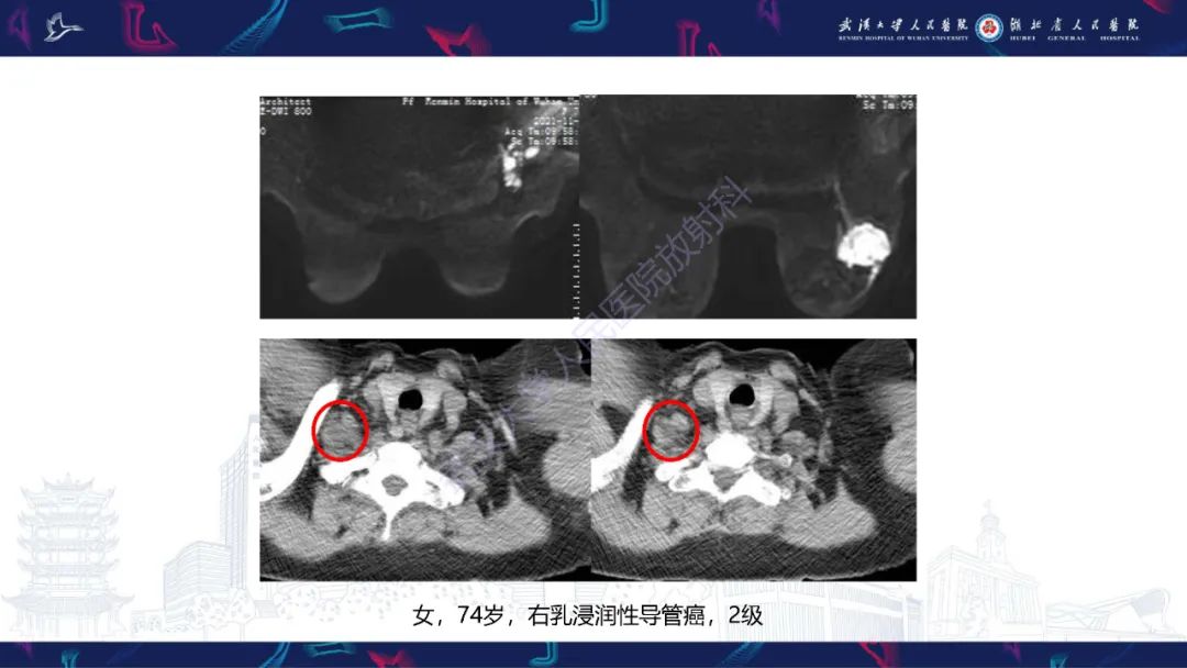 影像PPT - 【PPT】乳腺癌淋巴结影像评估-31