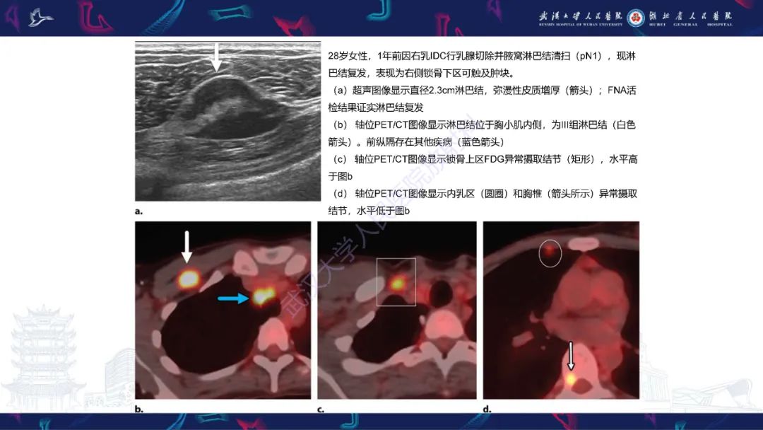 影像PPT - 【PPT】乳腺癌淋巴结影像评估-33