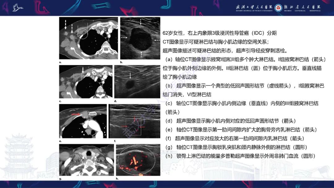 影像PPT - 【PPT】乳腺癌淋巴结影像评估-25