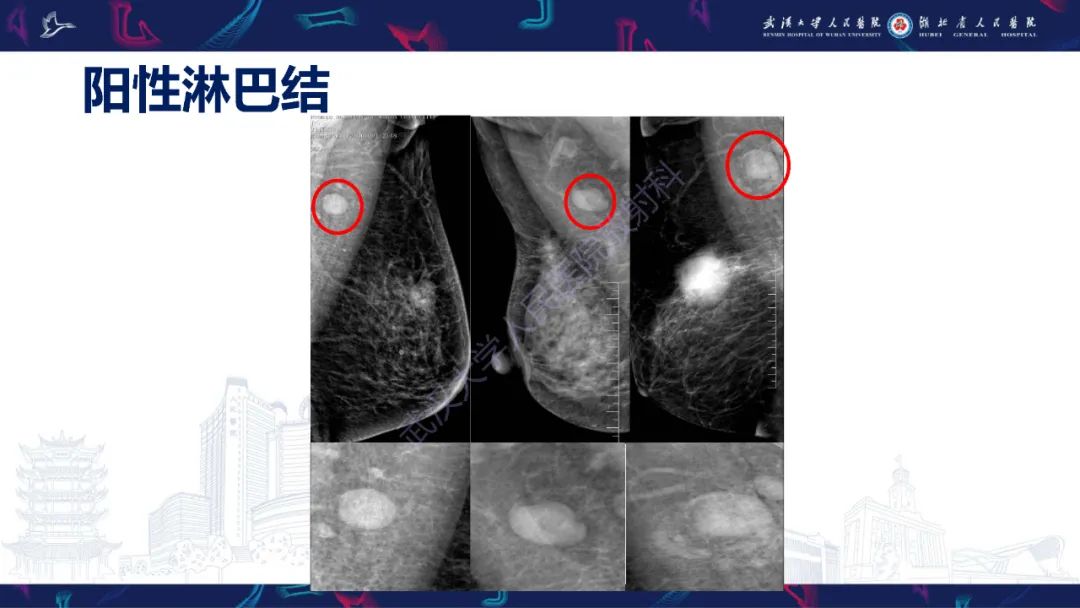 影像PPT - 【PPT】乳腺癌淋巴结影像评估-28