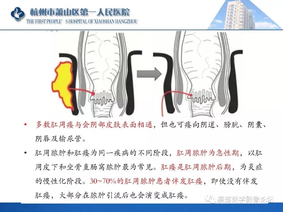 影像PPT - 【PPT】肛瘘MRI诊断-8 影像PPT - 【PPT】肛瘘MRI诊断-8