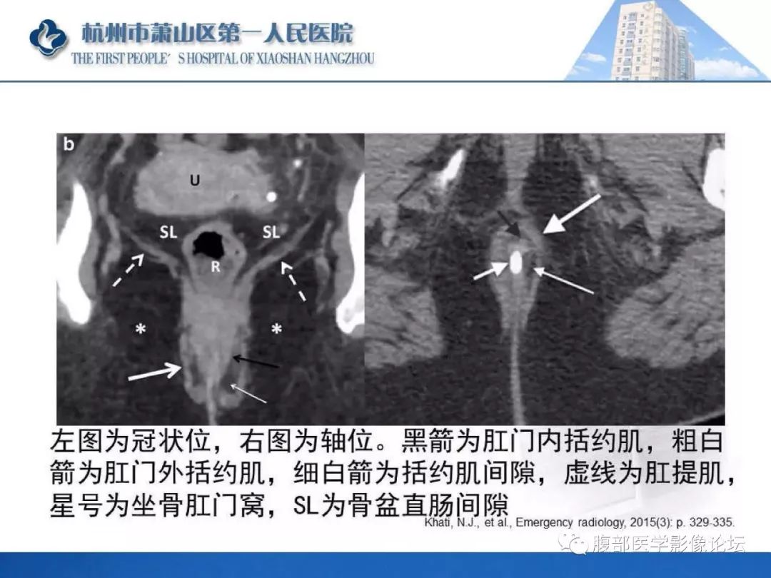 影像PPT - 【PPT】肛瘘MRI诊断-11 影像PPT - 【PPT】肛瘘MRI诊断-11