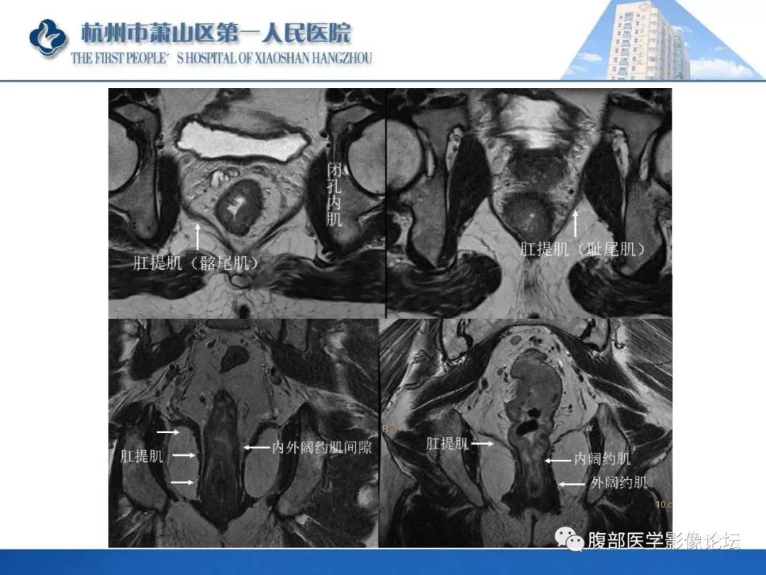 影像PPT - 【PPT】肛瘘MRI诊断-12 影像PPT - 【PPT】肛瘘MRI诊断-12