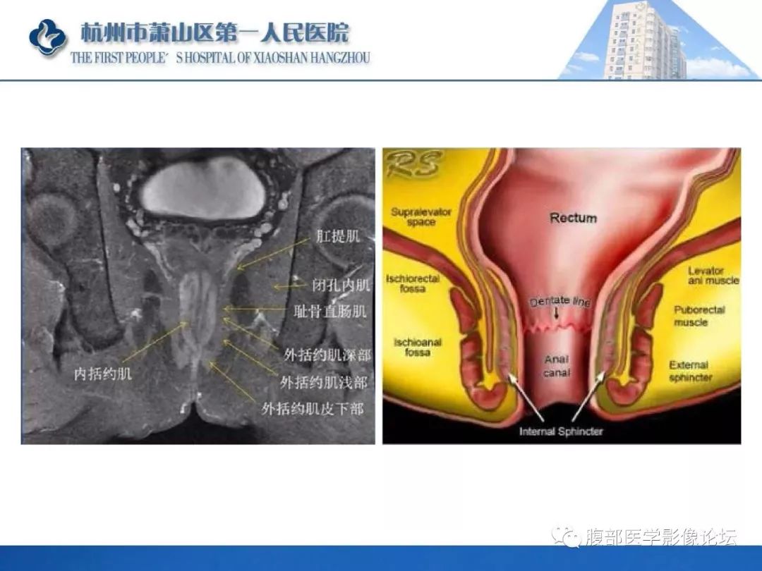 影像PPT - 【PPT】肛瘘MRI诊断-13 影像PPT - 【PPT】肛瘘MRI诊断-13