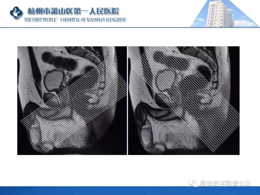 影像PPT - 【PPT】肛瘘MRI诊断-17 影像PPT - 【PPT】肛瘘MRI诊断-17