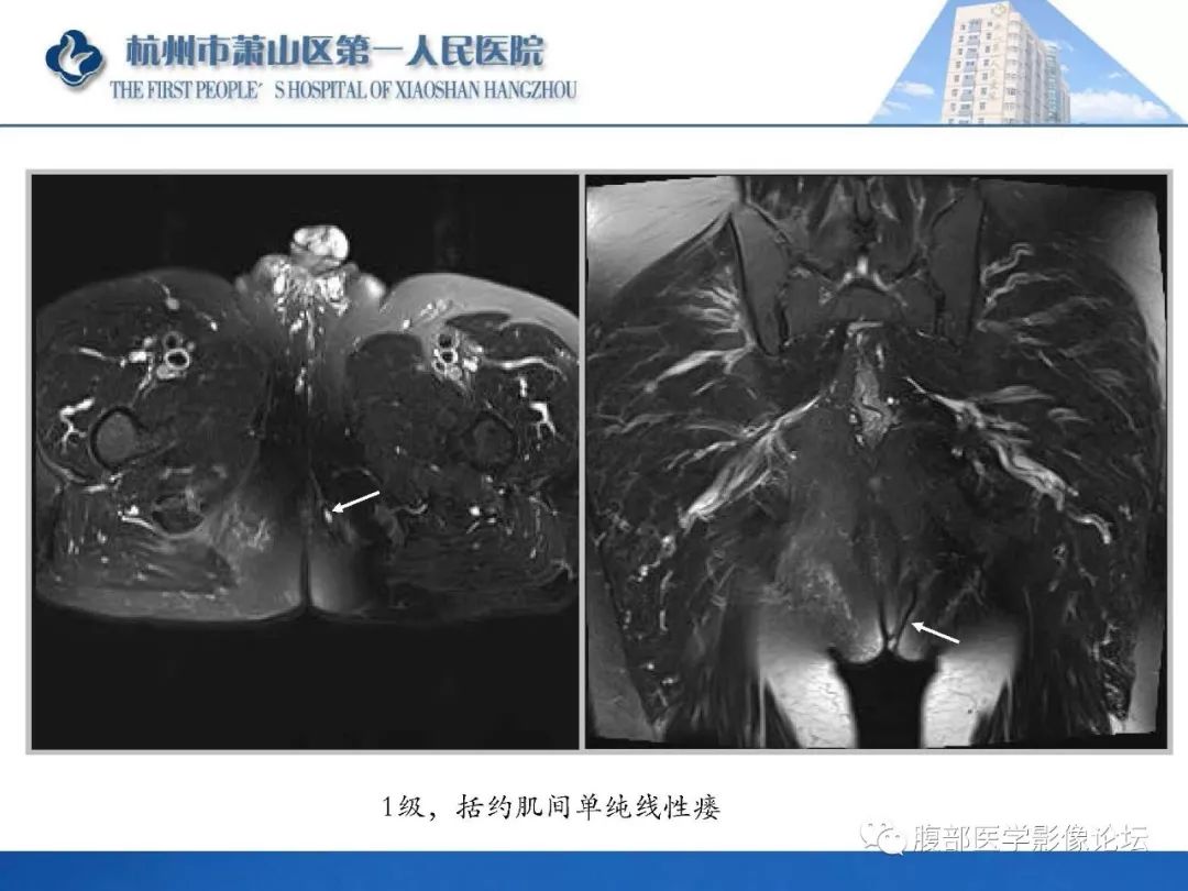 影像PPT - 【PPT】肛瘘MRI诊断-21 影像PPT - 【PPT】肛瘘MRI诊断-21