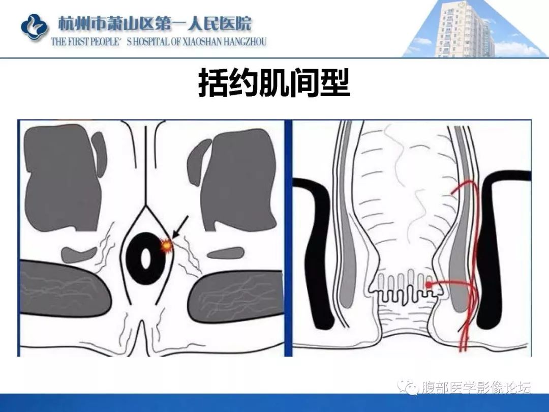 影像PPT - 【PPT】肛瘘MRI诊断-22 影像PPT - 【PPT】肛瘘MRI诊断-22