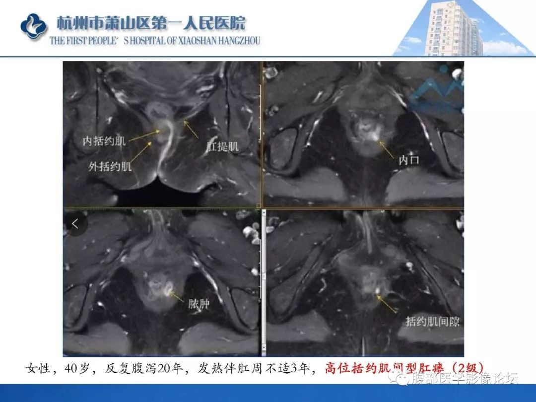 影像PPT - 【PPT】肛瘘MRI诊断-23 影像PPT - 【PPT】肛瘘MRI诊断-23